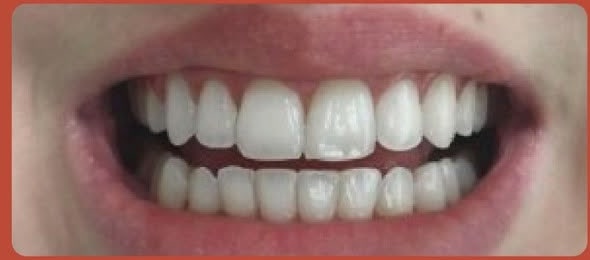 After Invisalign treatment at Dome MedDental