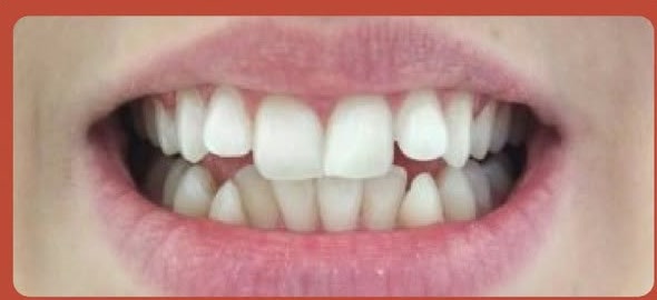 Before Invisalign treatment at Dome MedDental
